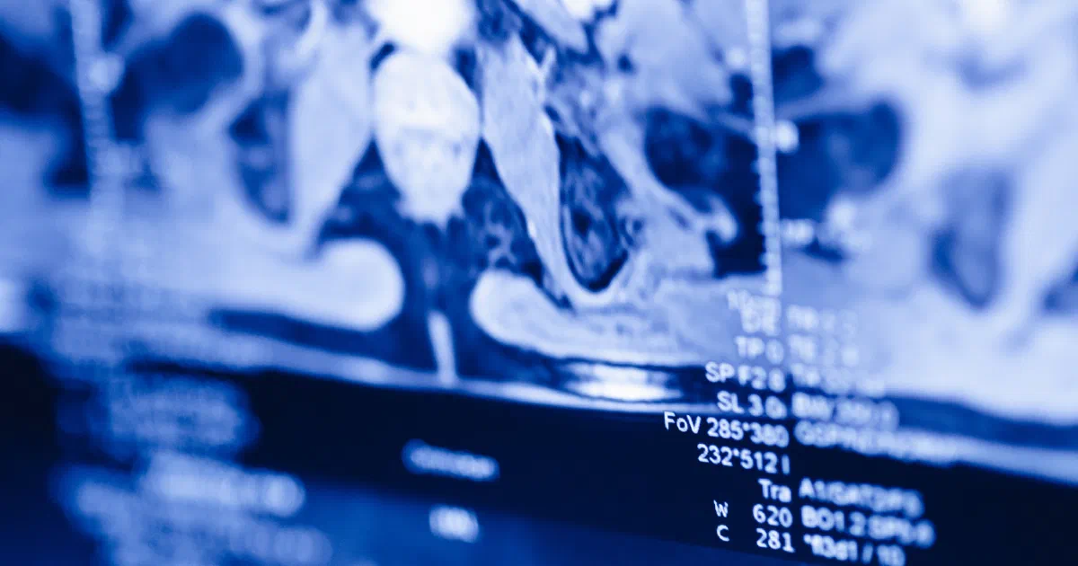 Close-up of an MR scan on a treatment planning screen